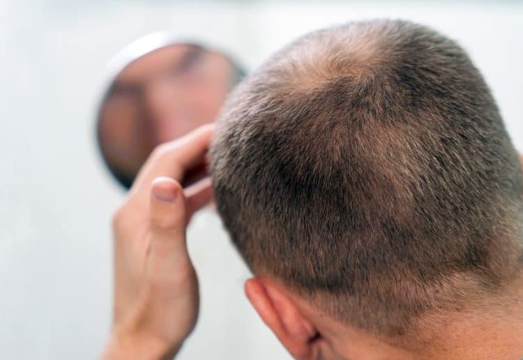 Balding Problems