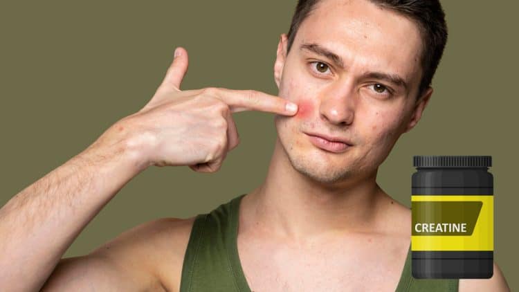 Does Creatine Cause Acne
