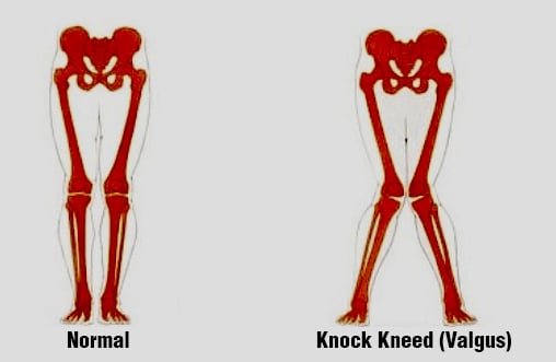 Knee Valgus