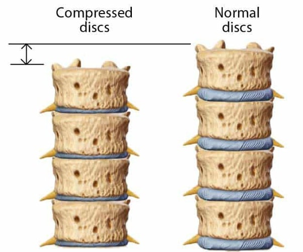 Normal And Compressed Discs