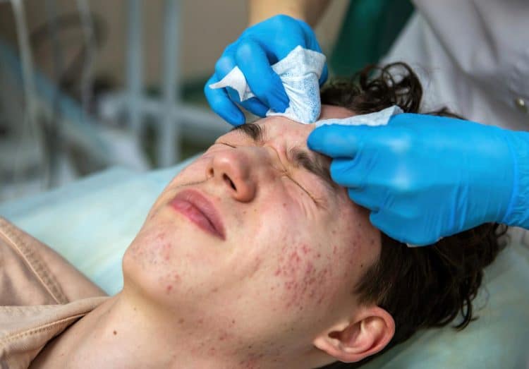 Testosterone And Acne